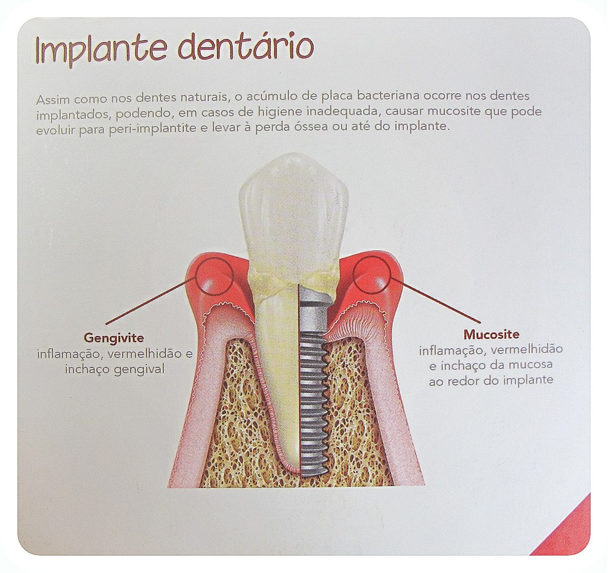 Implantes